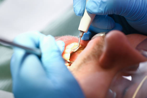 Best Broken or Chipped Tooth Repair in Glenville, CT